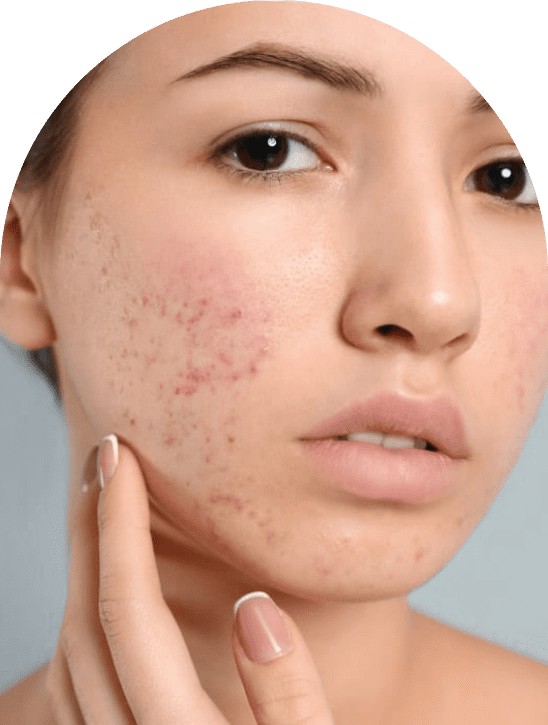 Acne Scar Treatment in Dubai Acne Scars Removal