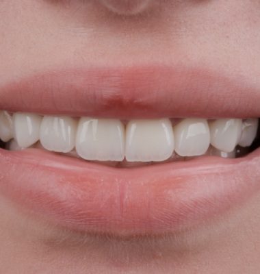 Veneers Treatment