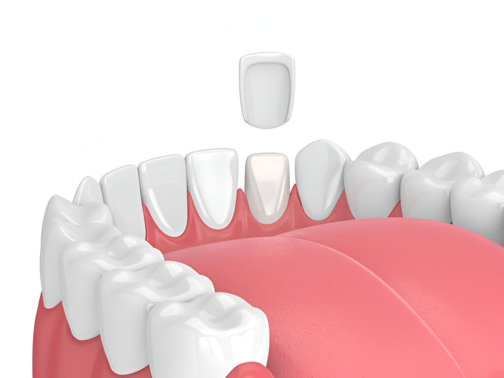 Dental crowns