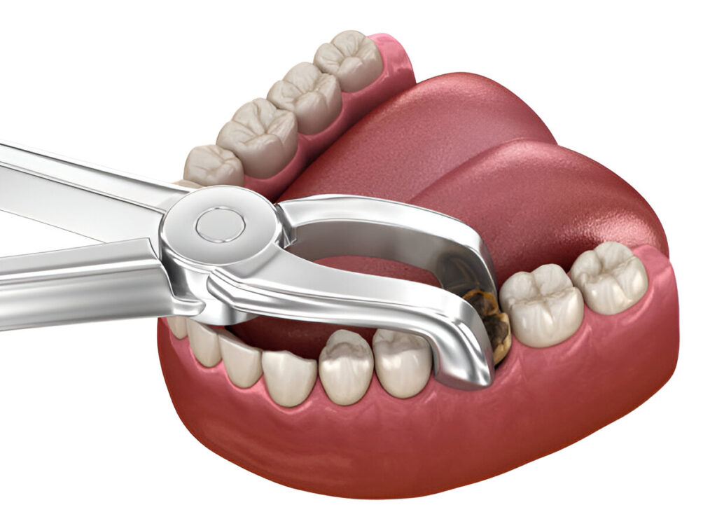 Wisdom Tooth Extraction