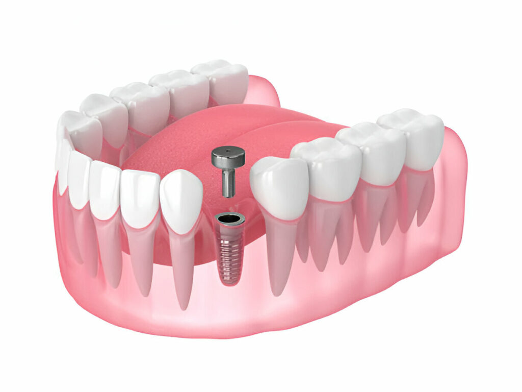 dental implant