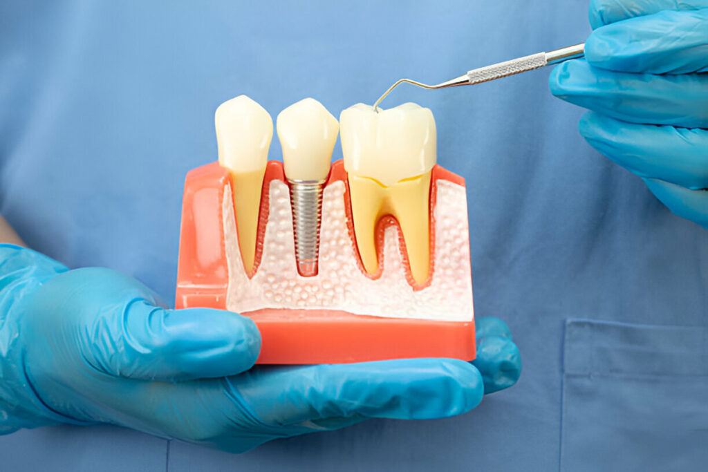 Dental Implants