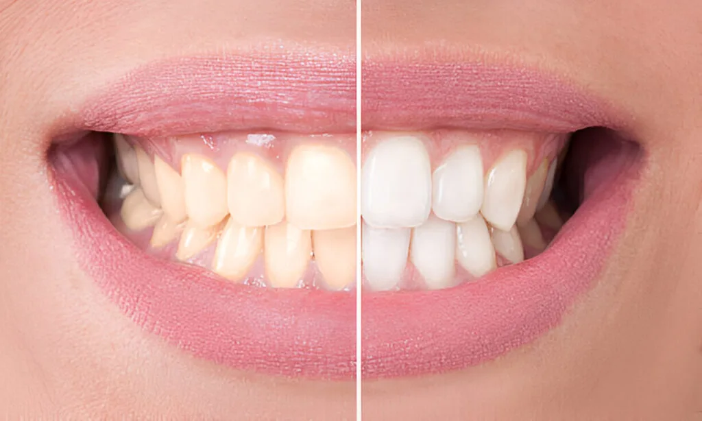 Whiten Teeth