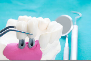Dental Implants