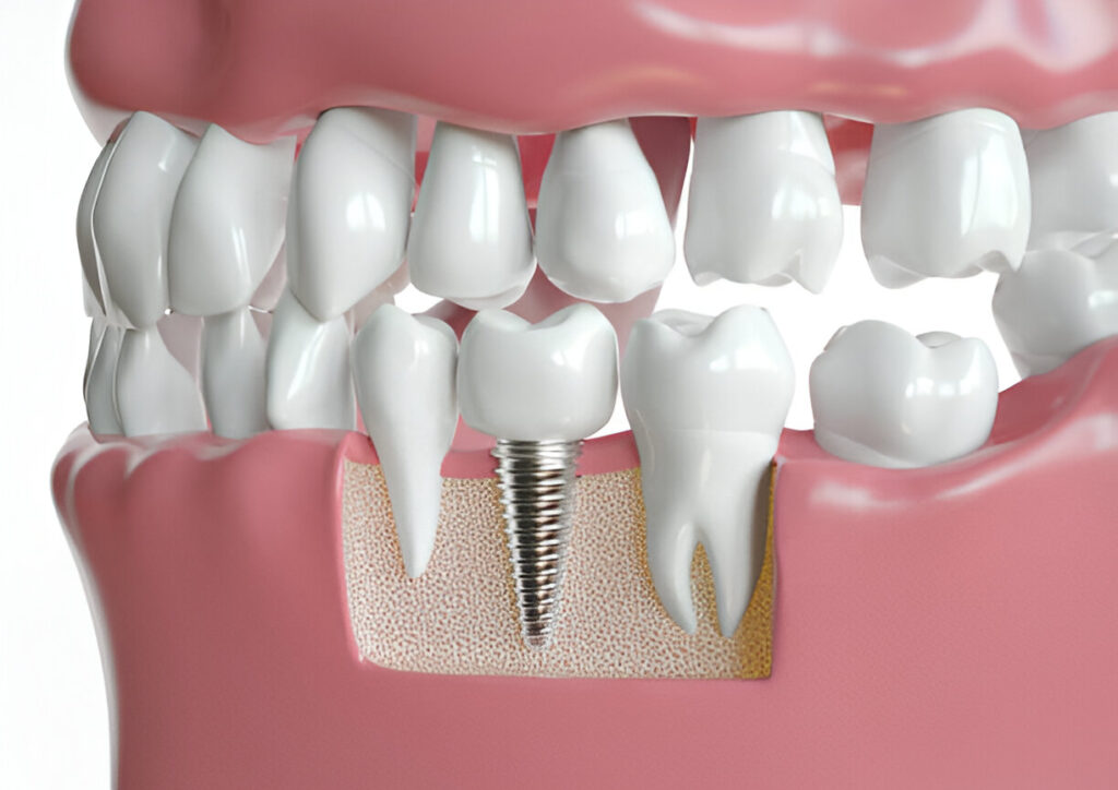 Dental Implants?