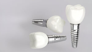 Dental Implant