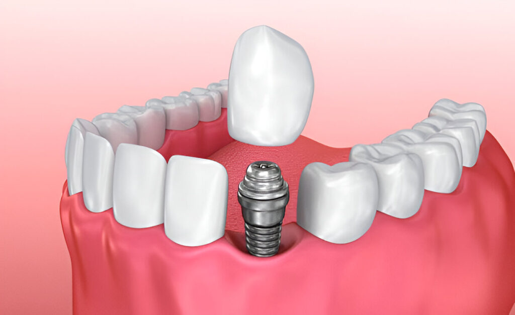 Teeth Implants