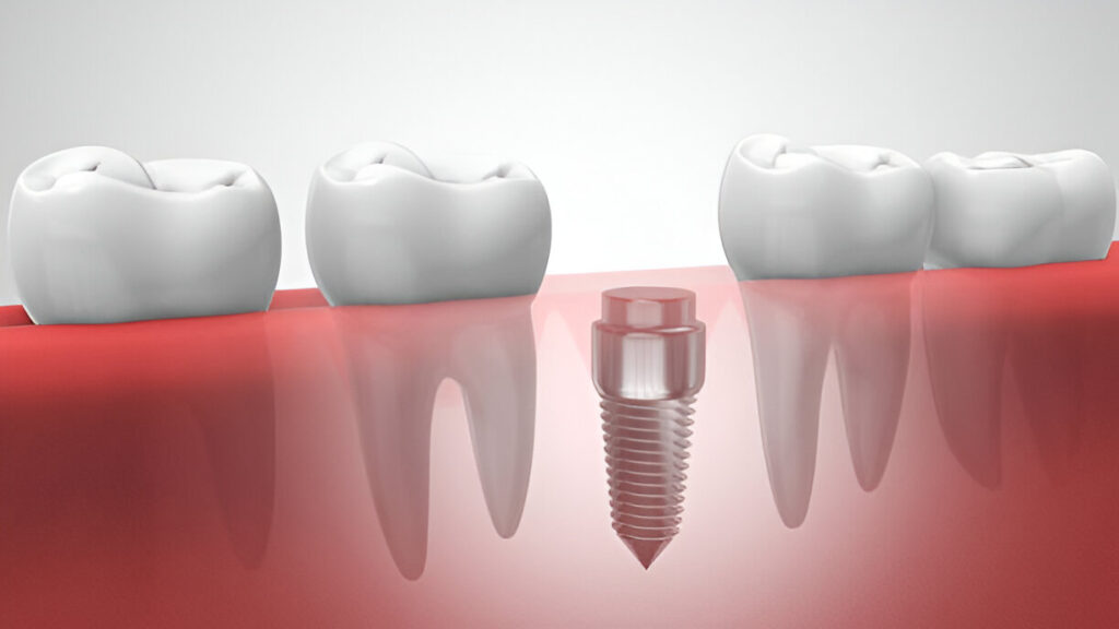 Teeth with Implants