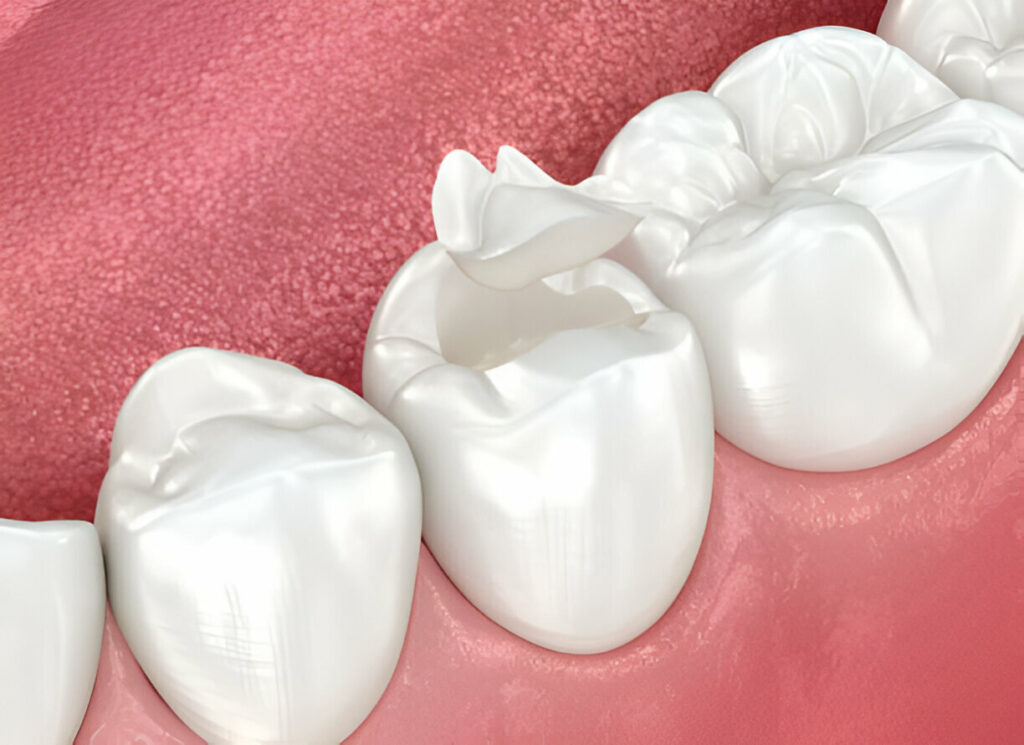 Composite Fillings