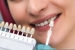 veneers