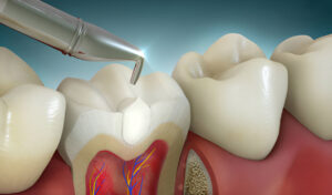 Composite Fillings