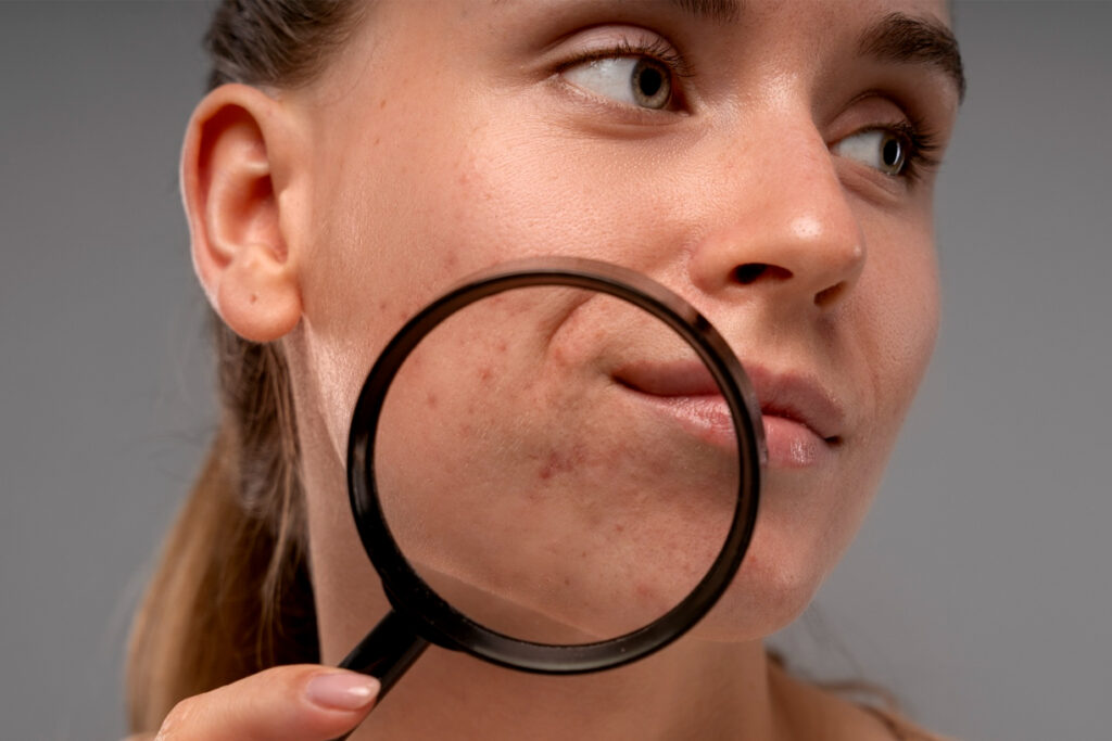 Risks of Acne Scar Treatments
