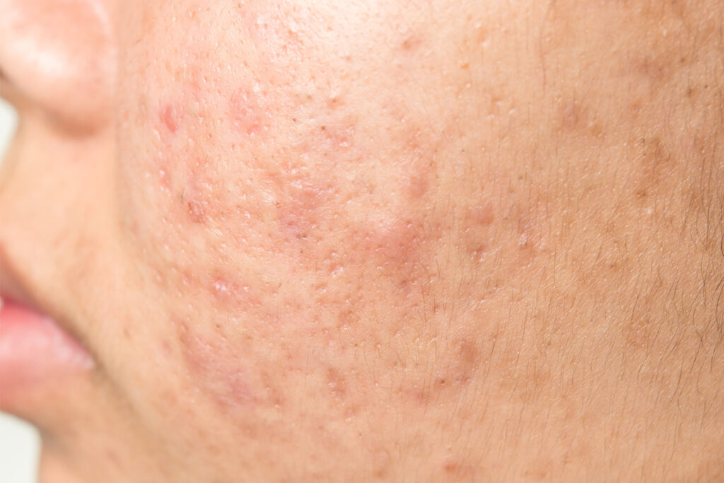 Aftercare for Acne Scar Treatment