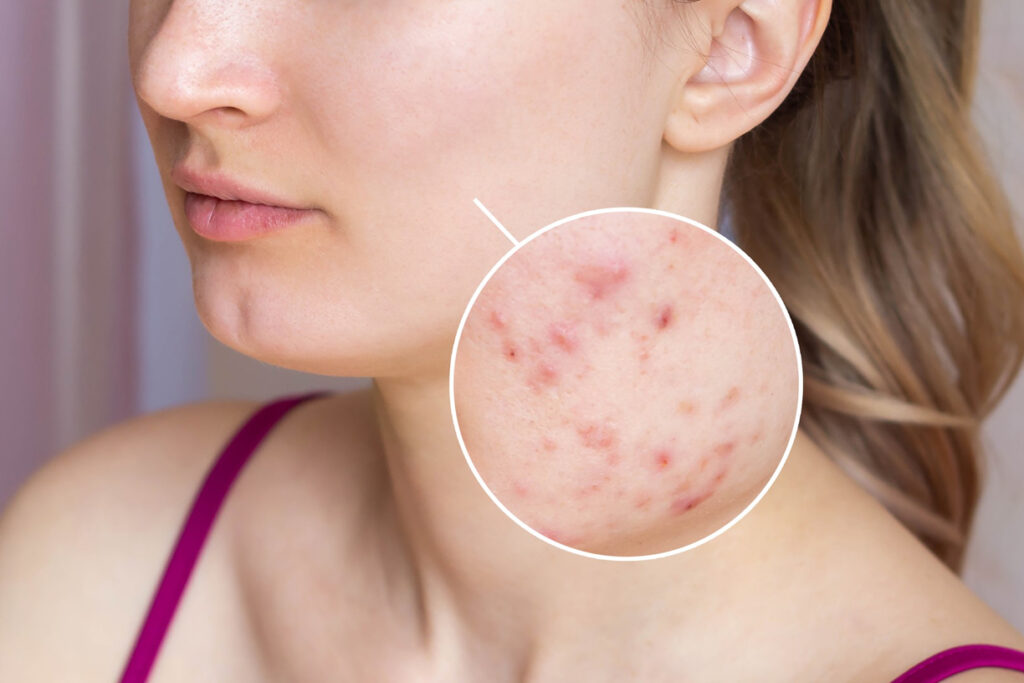Acne Scar Treatment Results