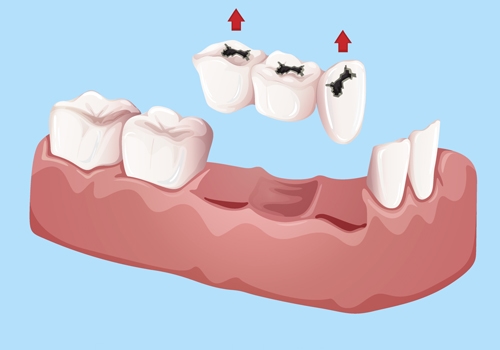 Dental Crown and Bridge Preparation