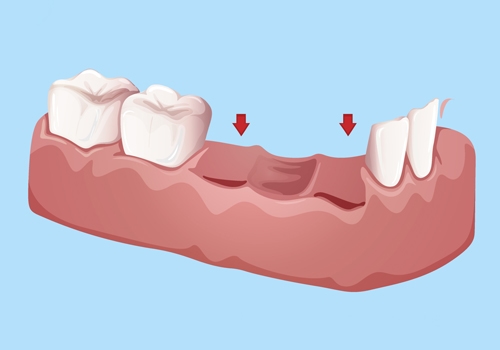 Dental Crown and Bridge Impressions