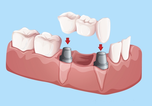 Dental crowns & bridgesTemporary Placement