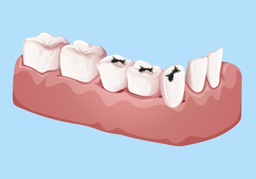 Dental Crown and Bridge Consultation