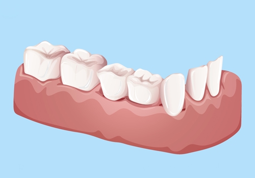 Dental Crown and Bridge Final Fitting