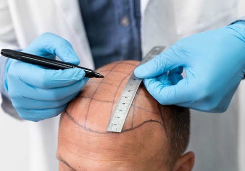 PRP Hair Treatment Injection