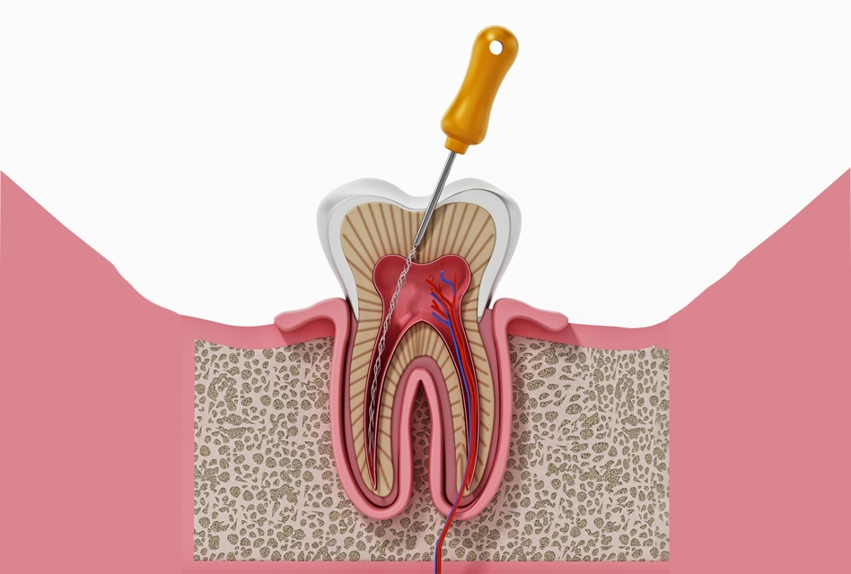 Root Canal