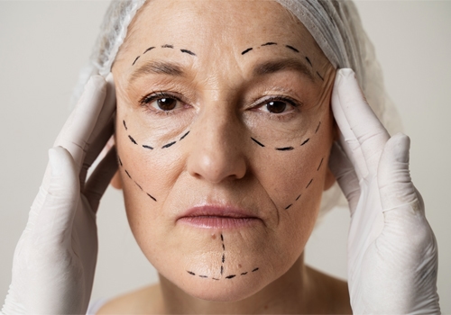 Thread Lift Procedure Duration