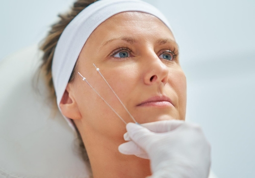 Thread Lift Procedure Technology