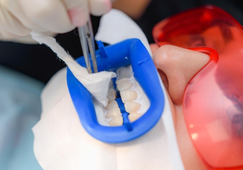 Teeth Whitening Treatment Personalized Plans