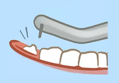 Tooth Removal-Procedure Extraction