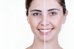 Teeth Whitening