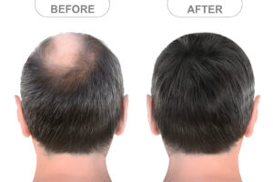 Hair Growth