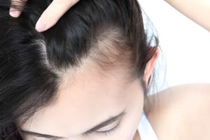 Best Treatment for Hair Growth